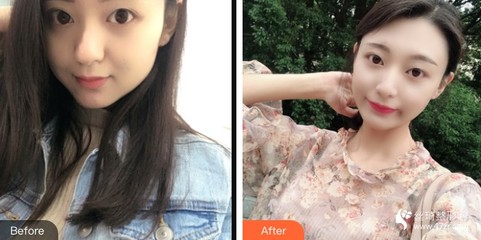 重慶愛德華醫院有限公司整形美(měi)容中心羅慧玲整形價格表附埋線提升案例展示